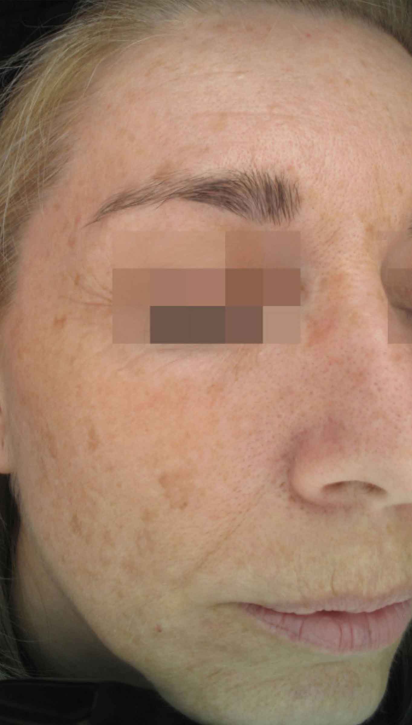 cosmelan-peel-before-after-picture-jenna-dee-skin-north-lakes-26