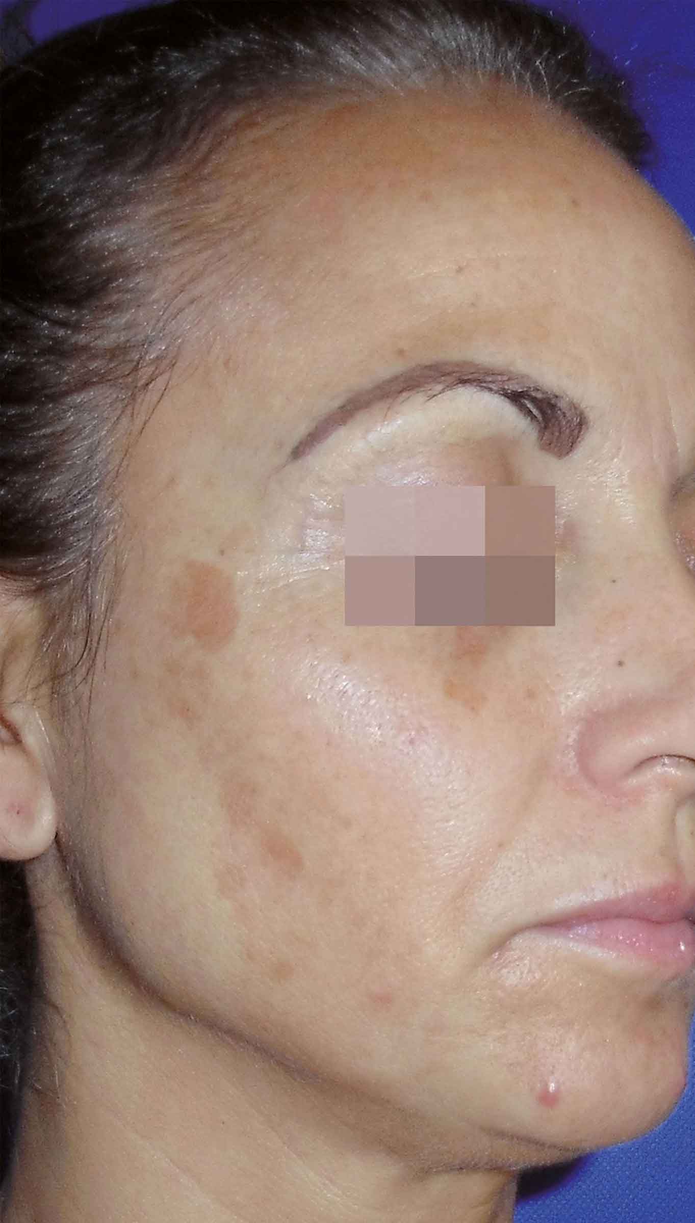 cosmelan-peel-before-after-picture-jenna-dee-skin-north-lakes-25