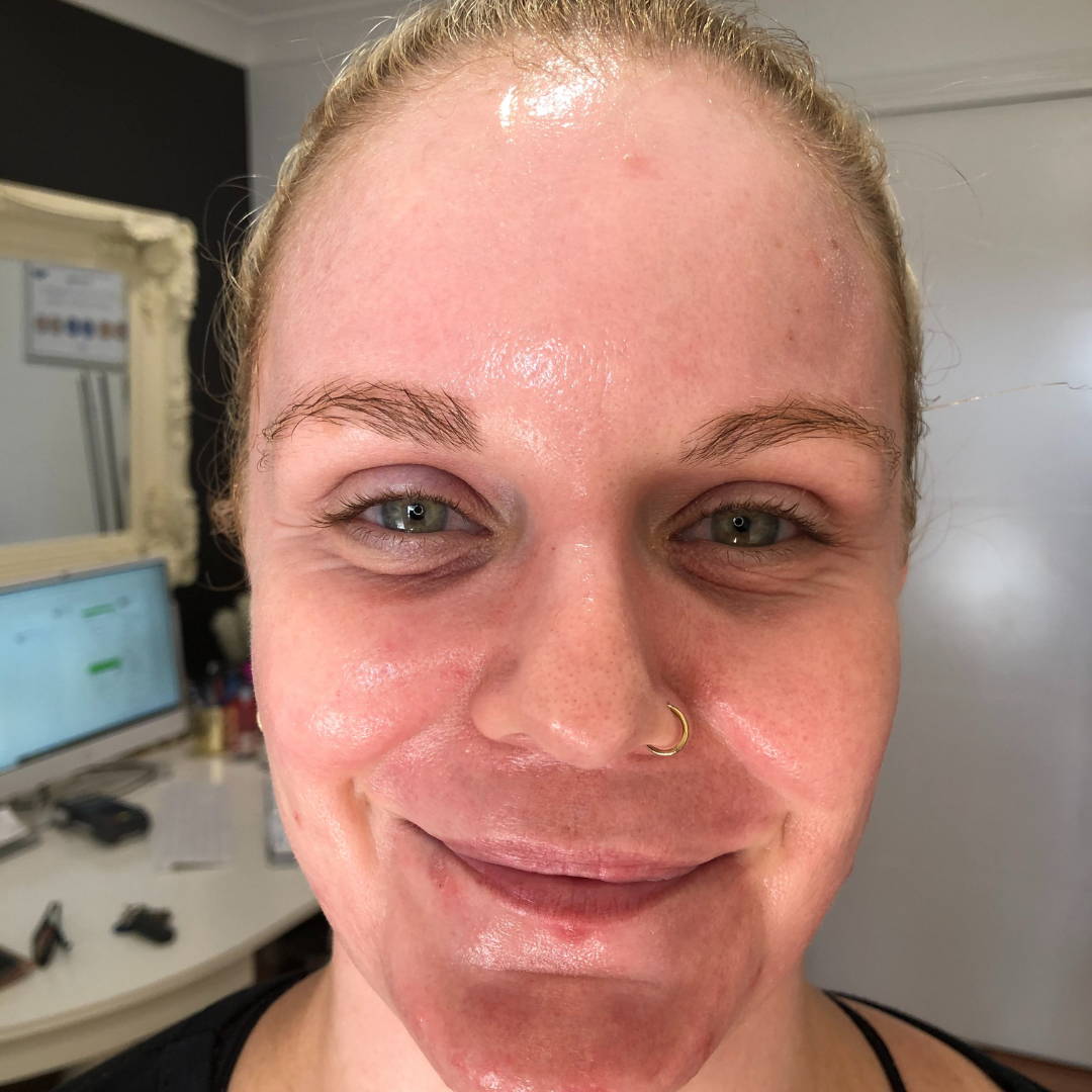 cosmelan-peel-before-and-after-pictures-jenna-dee-skin-brisbane-13