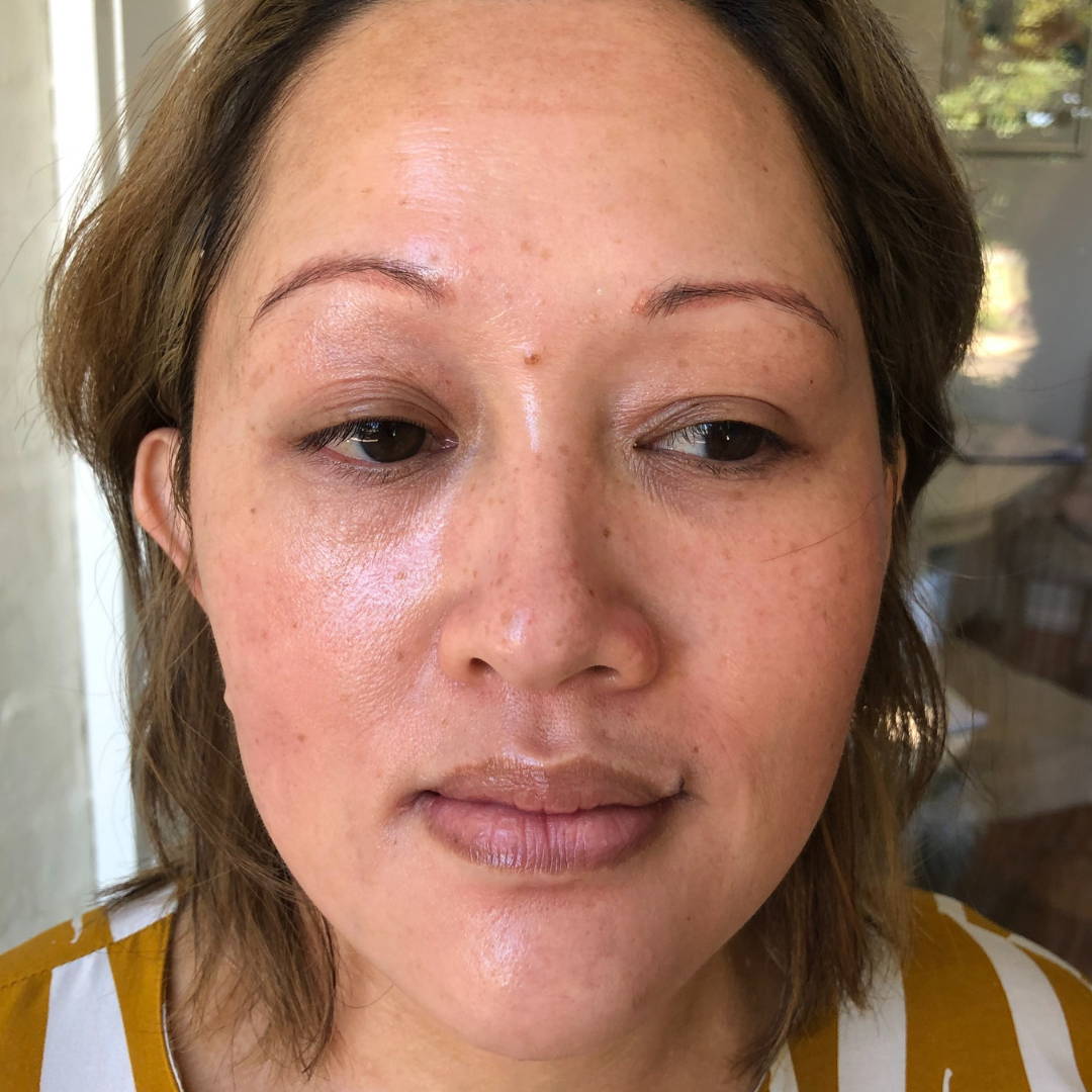 cosmelan-peel-before-and-after-pictures-jenna-dee-skin-brisbane-11