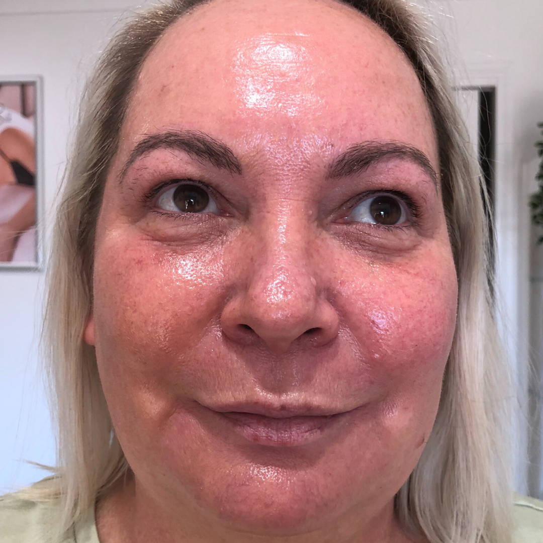 cosmelan-peel-before-and-after-pictures-jenna-dee-skin-brisbane-9
