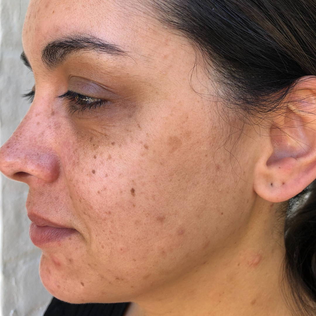 cosmelan-peel-before-and-after-pictures-jenna-dee-skin-brisbane-8