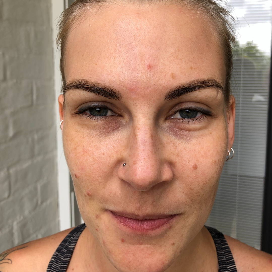 cosmelan-peel-before-and-after-pictures-jenna-dee-skin-brisbane-6