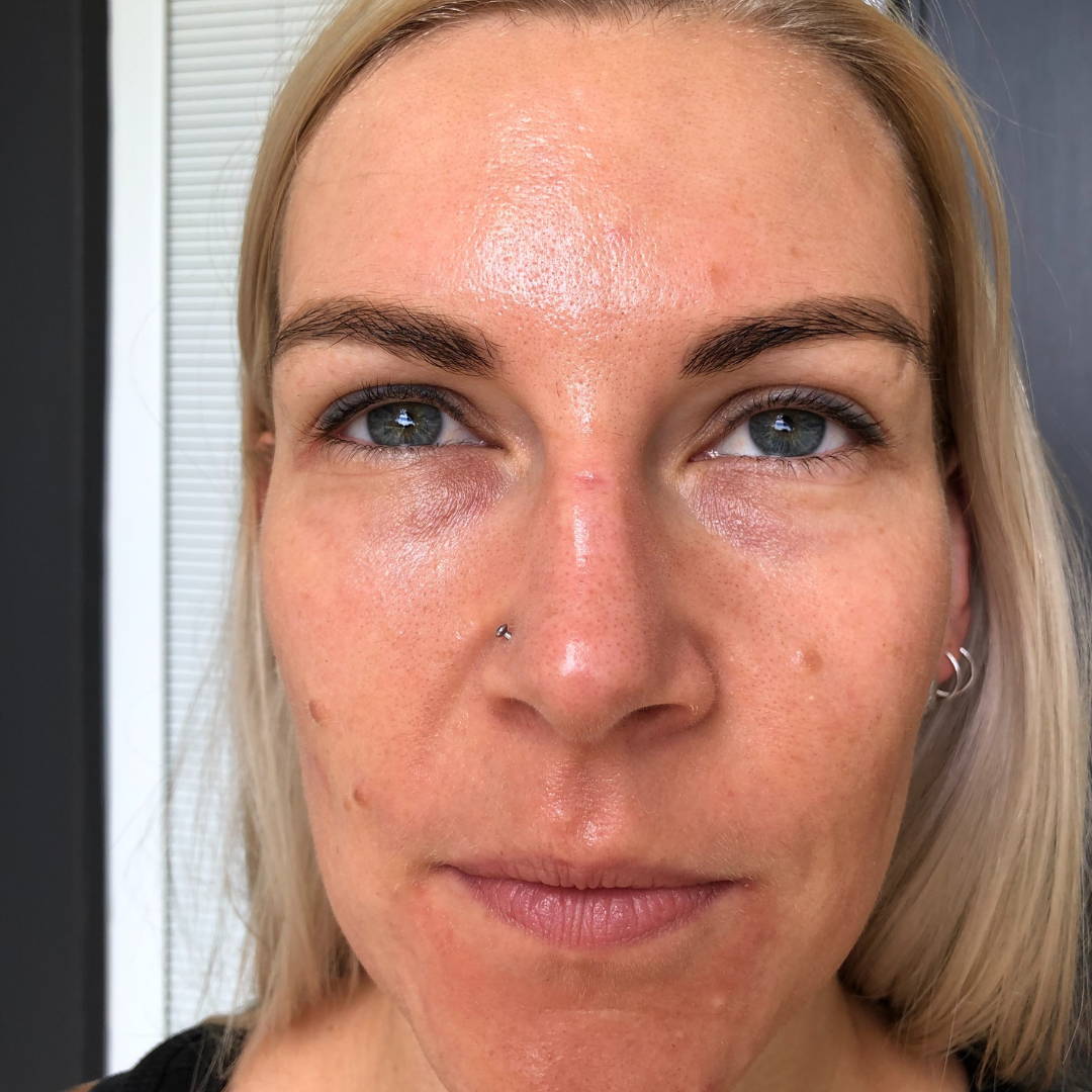 cosmelan-peel-before-and-after-pictures-jenna-dee-skin-brisbane-5