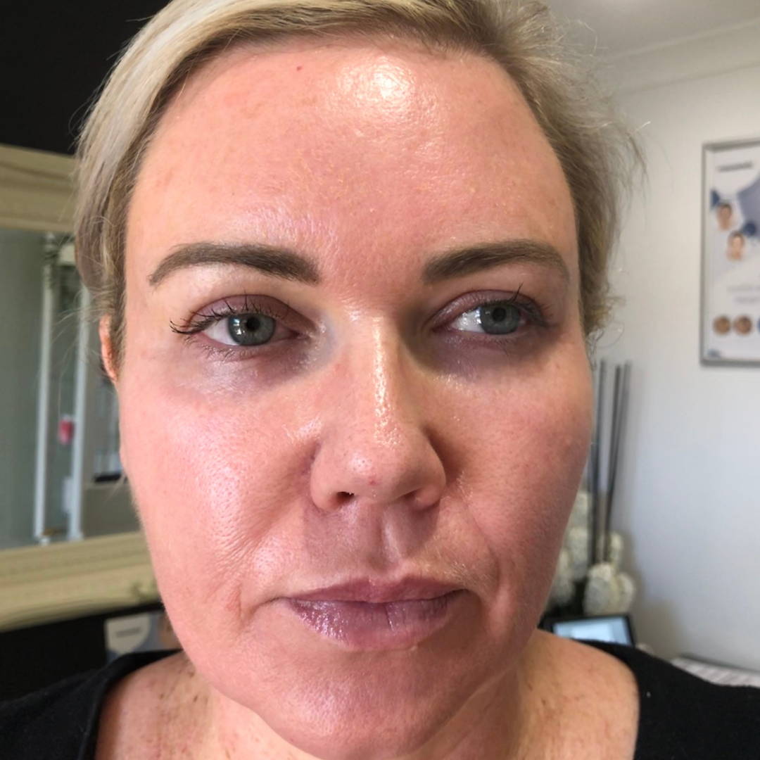 cosmelan-peel-before-and-after-pictures-jenna-dee-skin-brisbane-3