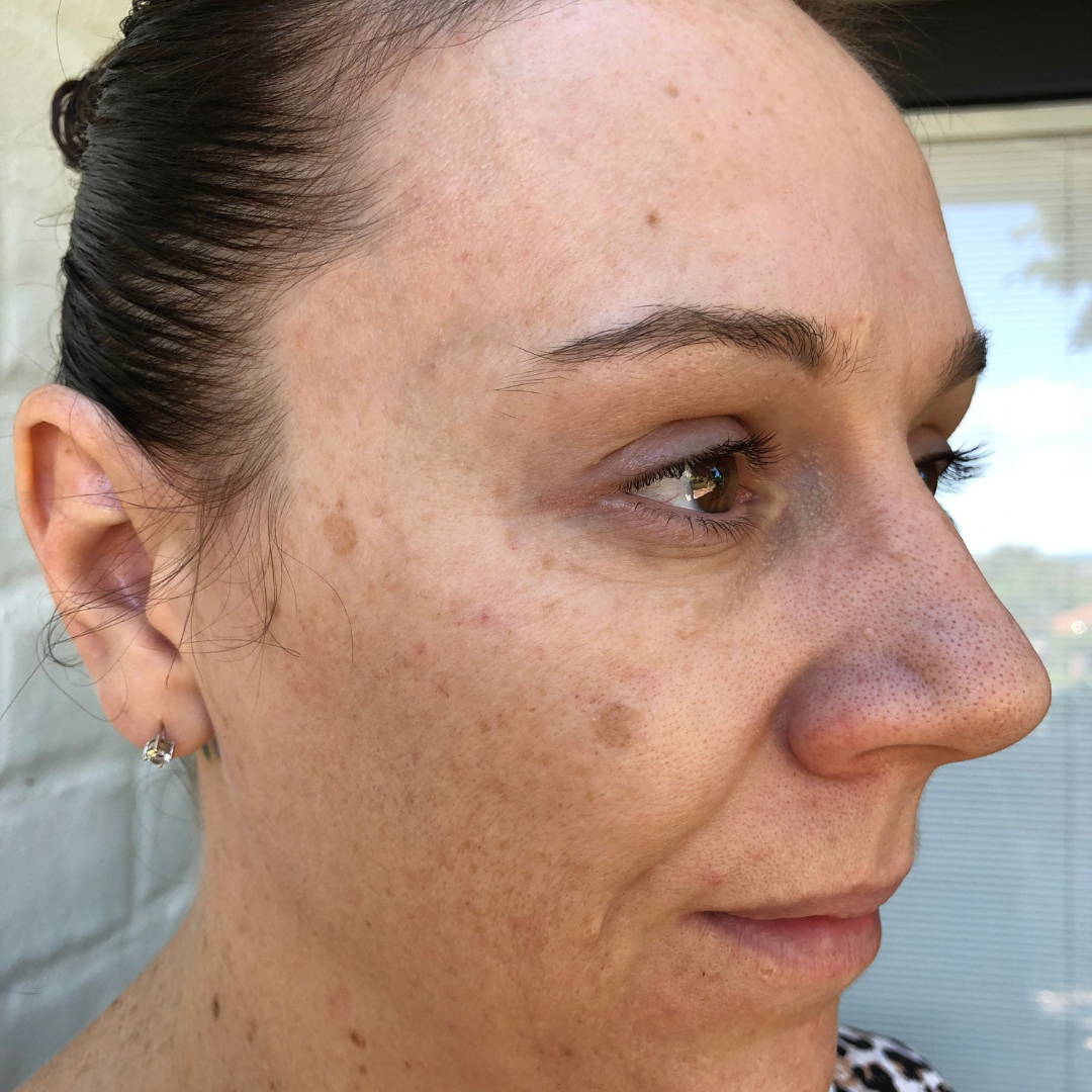 cosmelan-peel-before-and-after-pictures-jenna-dee-skin-brisbane-2