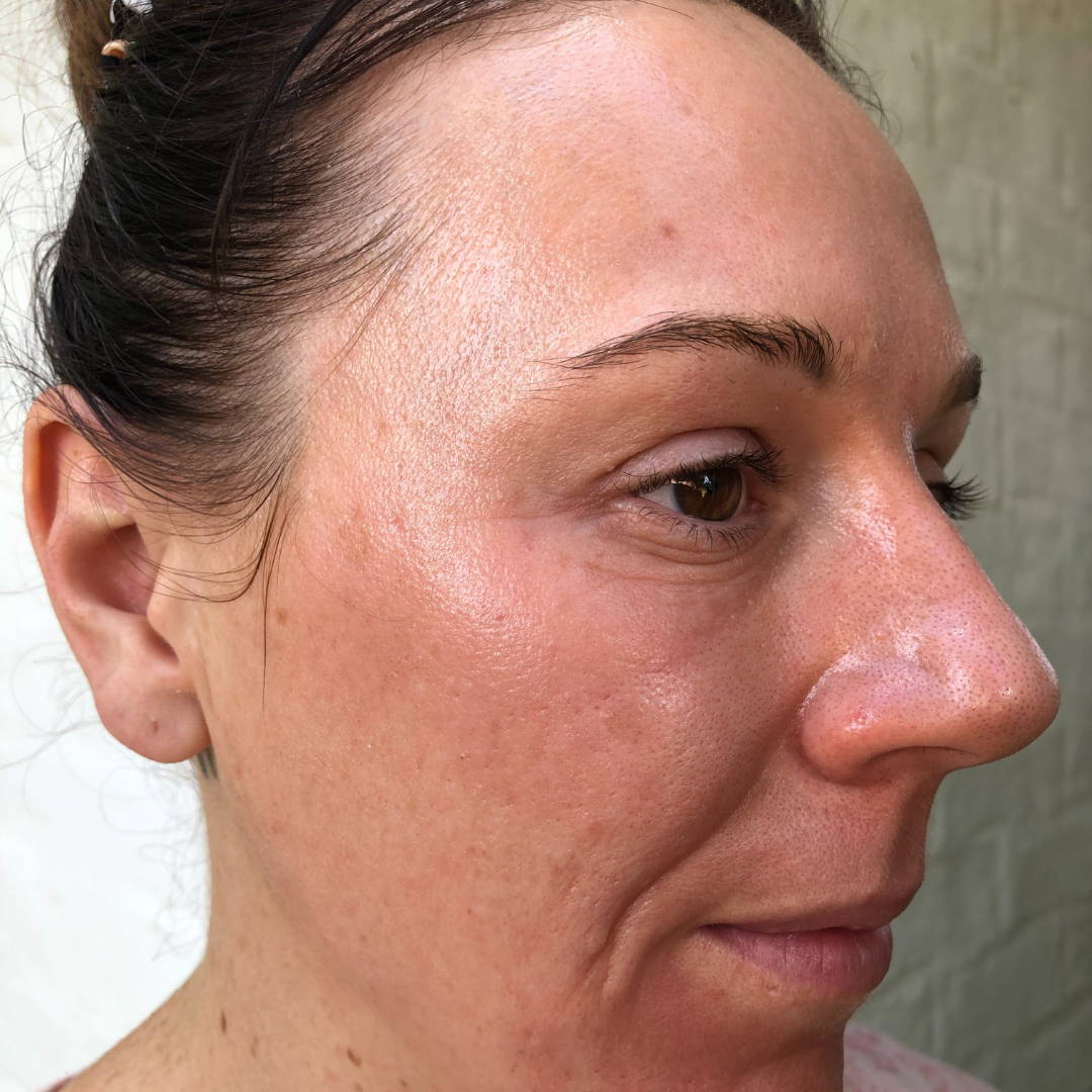 cosmelan-peel-before-and-after-pictures-jenna-dee-skin-brisbane-1